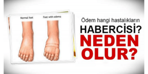 Ödem Hangi Hastalıkların Habercisidir. Meğerse en büyük sebebi buymuş..