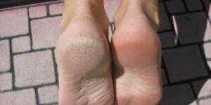 Topuk Çatlaklarınıza Doğal Çözüm T’arifi